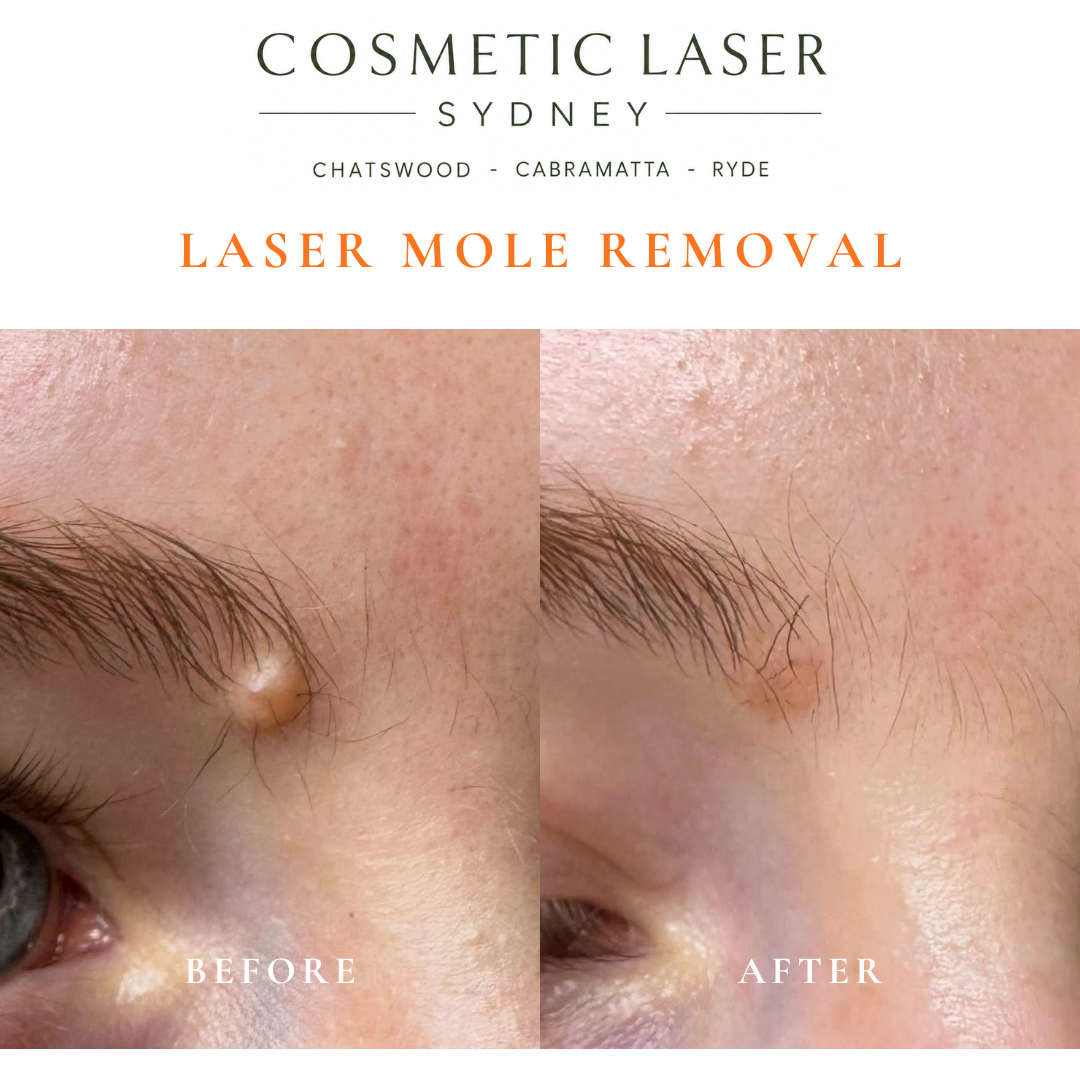 before after laser mole removal eyebrow