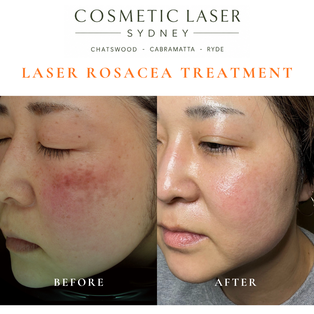 Before and after laser treatment for rosacea and melasma showing reduced facial redness, visible blood vessels, and pigmentation.