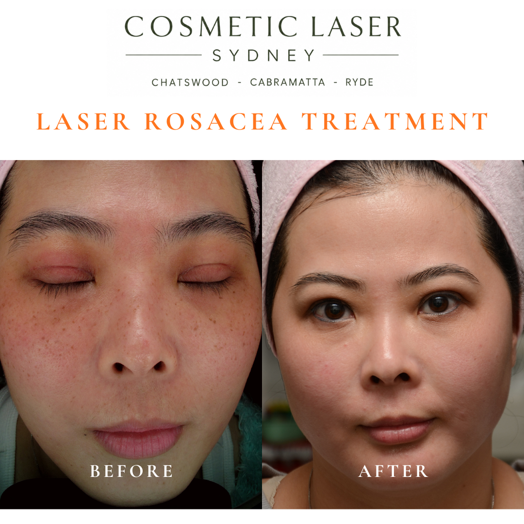"Before and after laser treatment for rosacea and facial freckles, showing reduced cheek redness and improved skin pigmentation."
