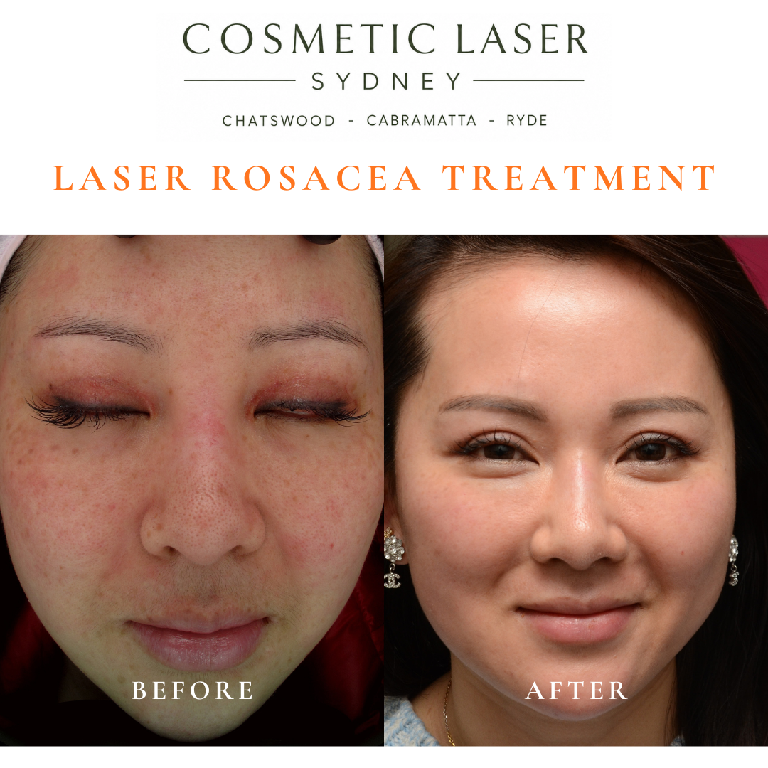 Before and after eight laser treatment sessions for rosacea and generalized facial pigmentation in Asian skin, showing reduced redness and a more even complexion.