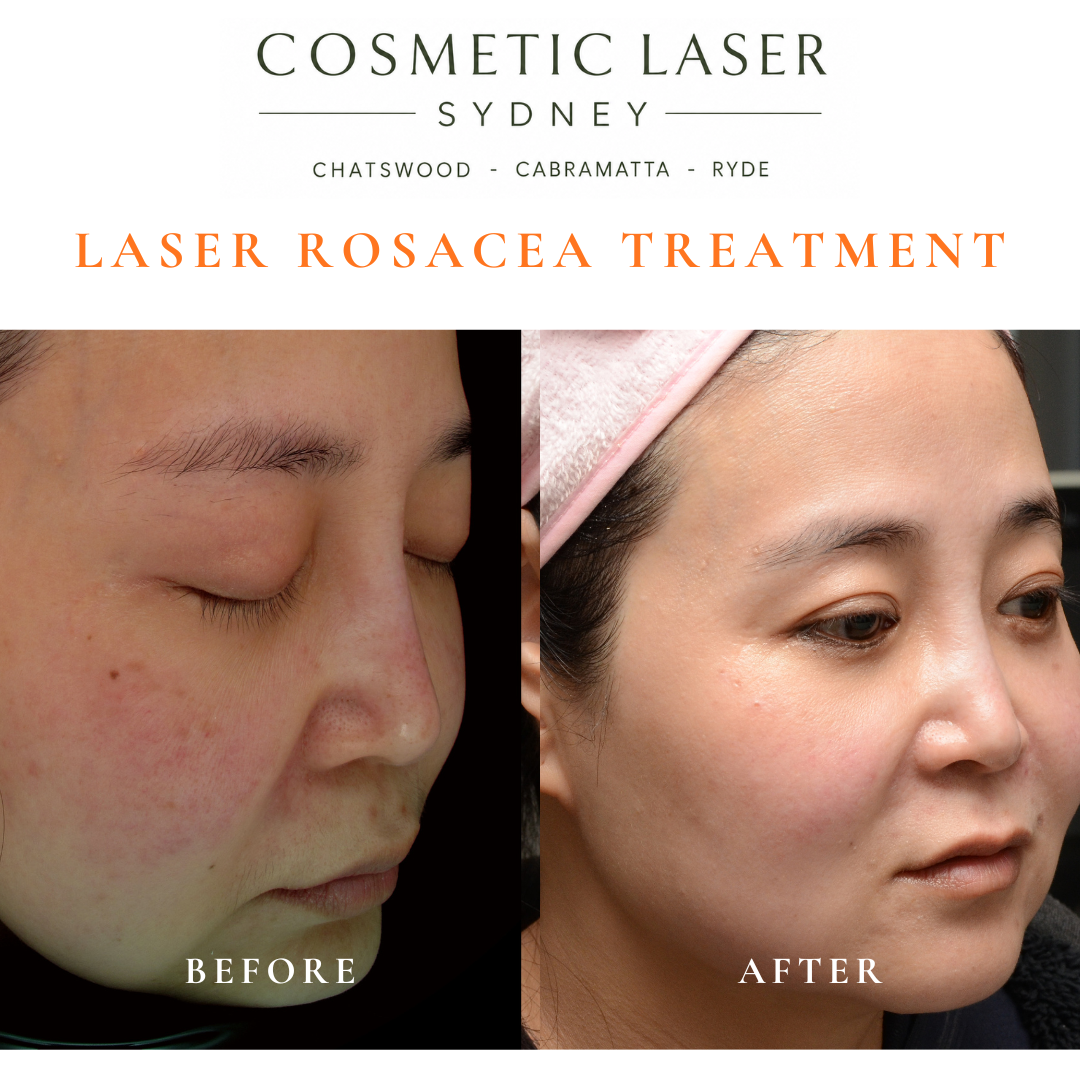 Before and after six laser treatment sessions for rosacea and facial pigmentation in Asian skin, showing reduced redness, pimples, and pigmentation.