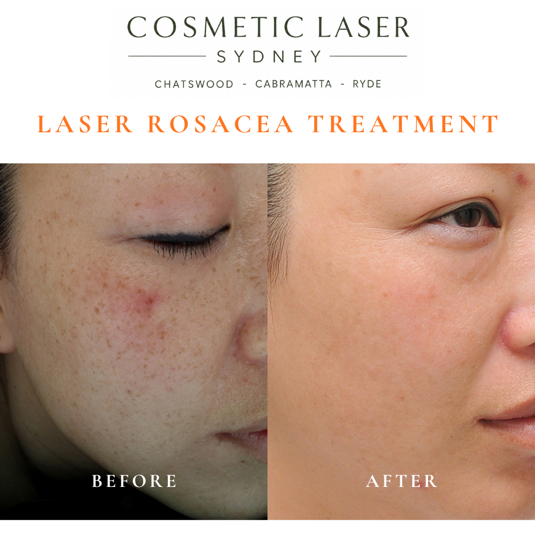 Before and after laser treatment for freckles, rosacea, and broken facial capillaries, showing clearer skin, reduced redness, and improved skin tone.