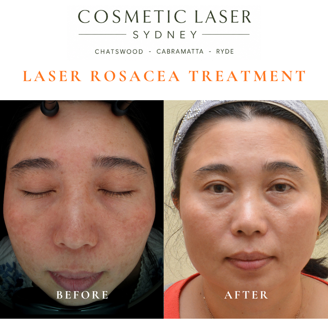 "Before and after laser treatment for rosacea and diffuse melasma in Asian skin, showing reduced facial redness and pigmentation."