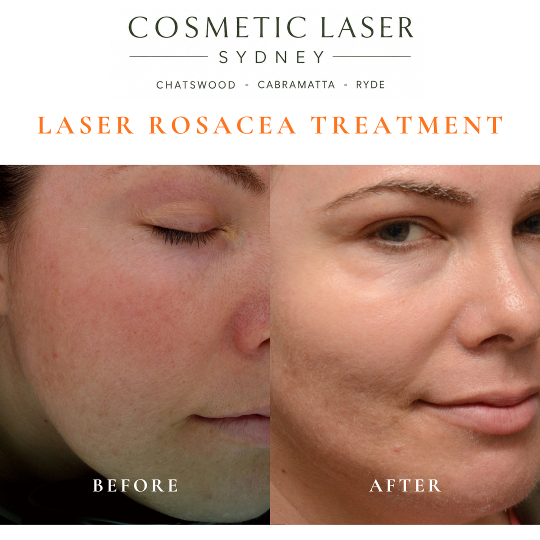 "Before and after eight laser treatment sessions for rosacea and melasma, showing reduced facial redness and pigmentation."
