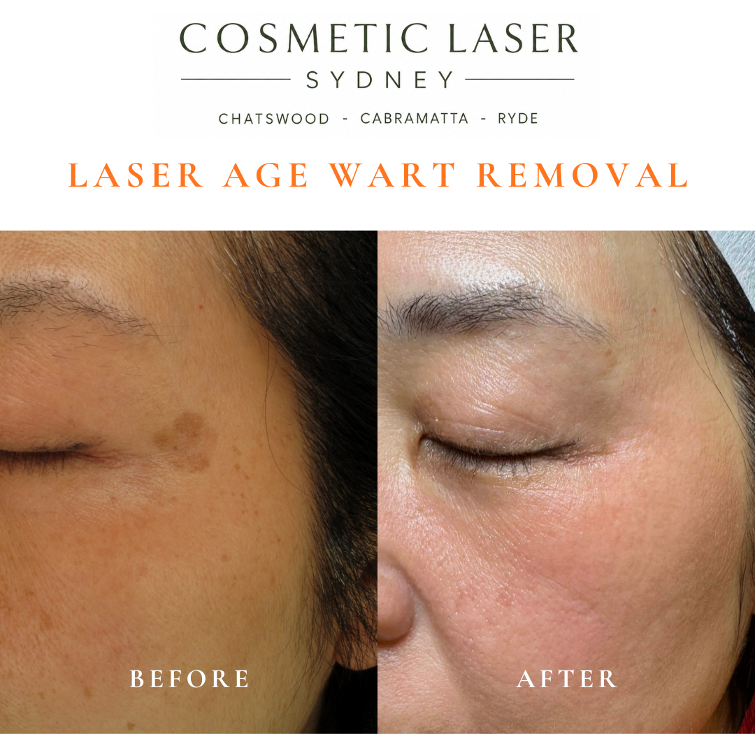 Asian female patient before and after laser skin whitening treatment for seborrheic keratosis age spots, melasma, freckles, and uneven skin tone.