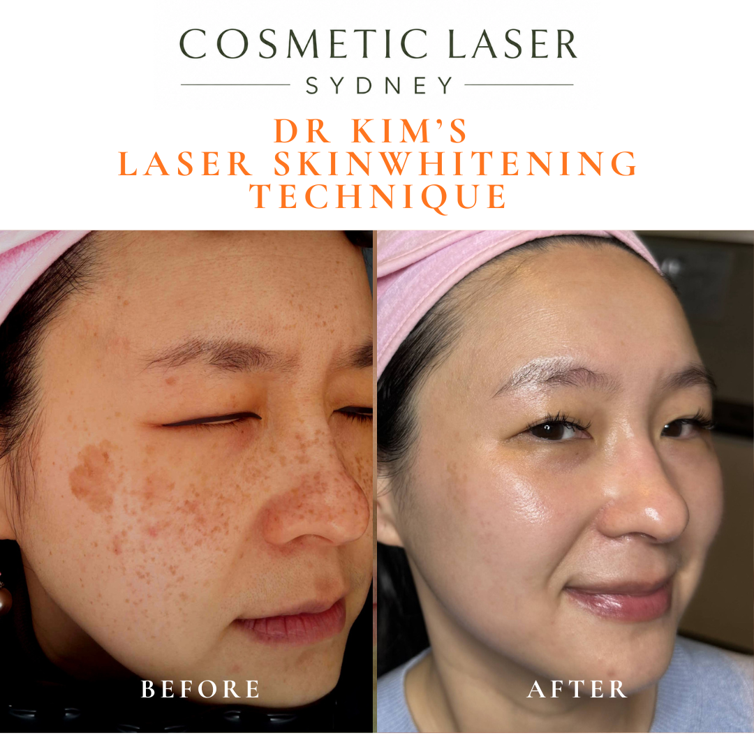 before after laser skin rejuvneation for asian skin using dr peter kim's laser skin whitening technique