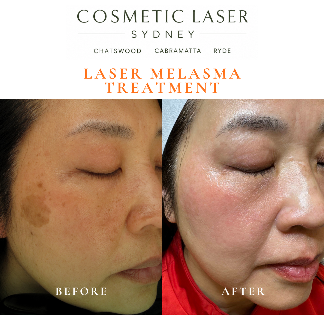 Before and after comparison of an Asian female patient treated for melasma, freckles, age spots, and uneven skin tone using laser skin whitening therapy.