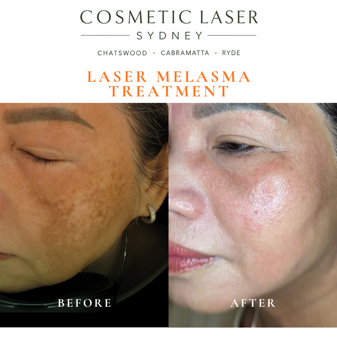 Before and after laser treatment for melasma in vietnamese asian affecting both cheeks using Dr Peter Kim's Laser Skin Whitening Technique after six sessions.