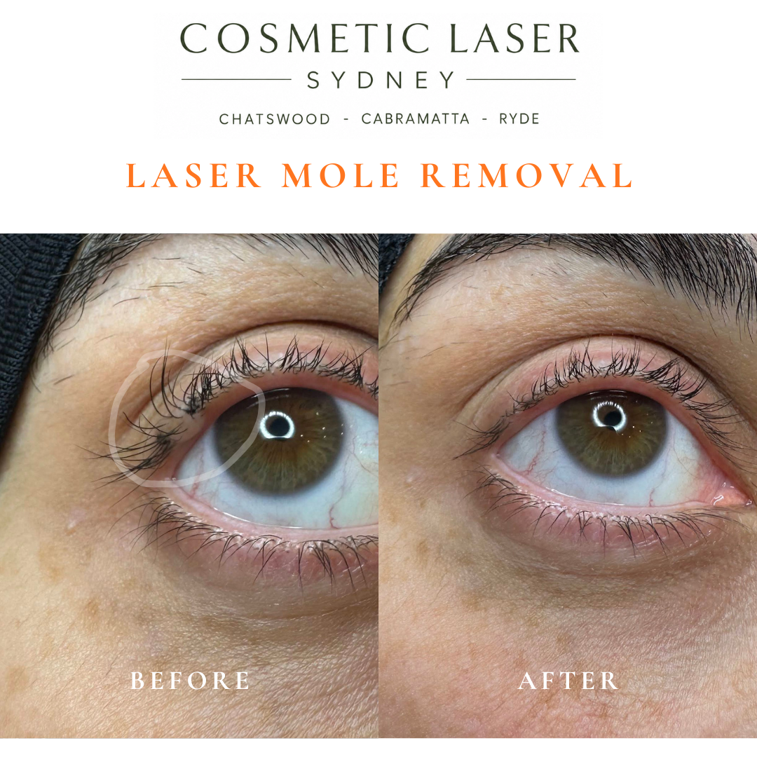 Before and after CO₂ laser removal of a mole on the right eyelid margin with preservation of the eyelashes.