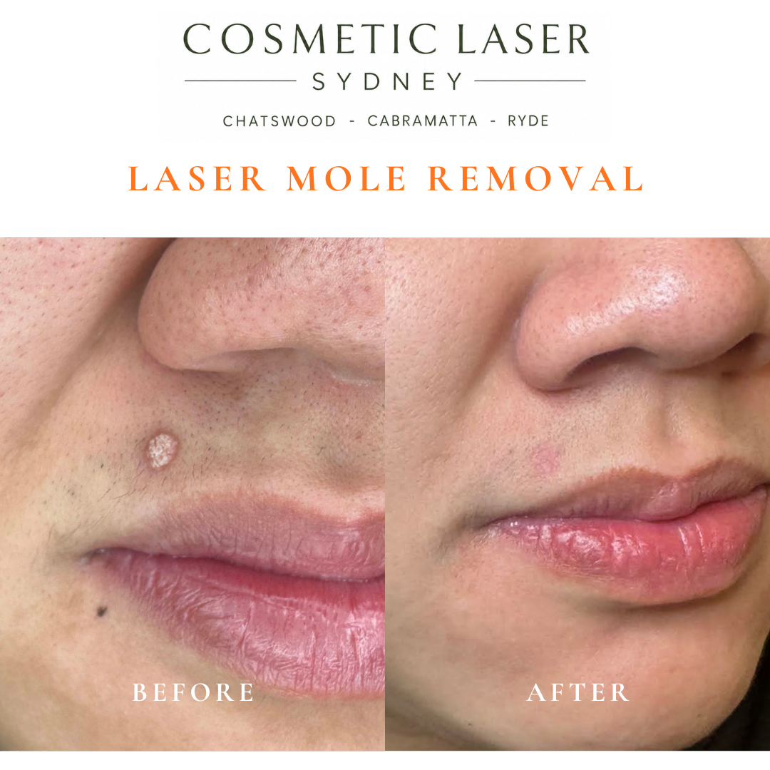 Before and after CO₂ laser removal of a skin wart on the right upper lip, showing healing 6 weeks after treatment. In our cabramatta clinic.