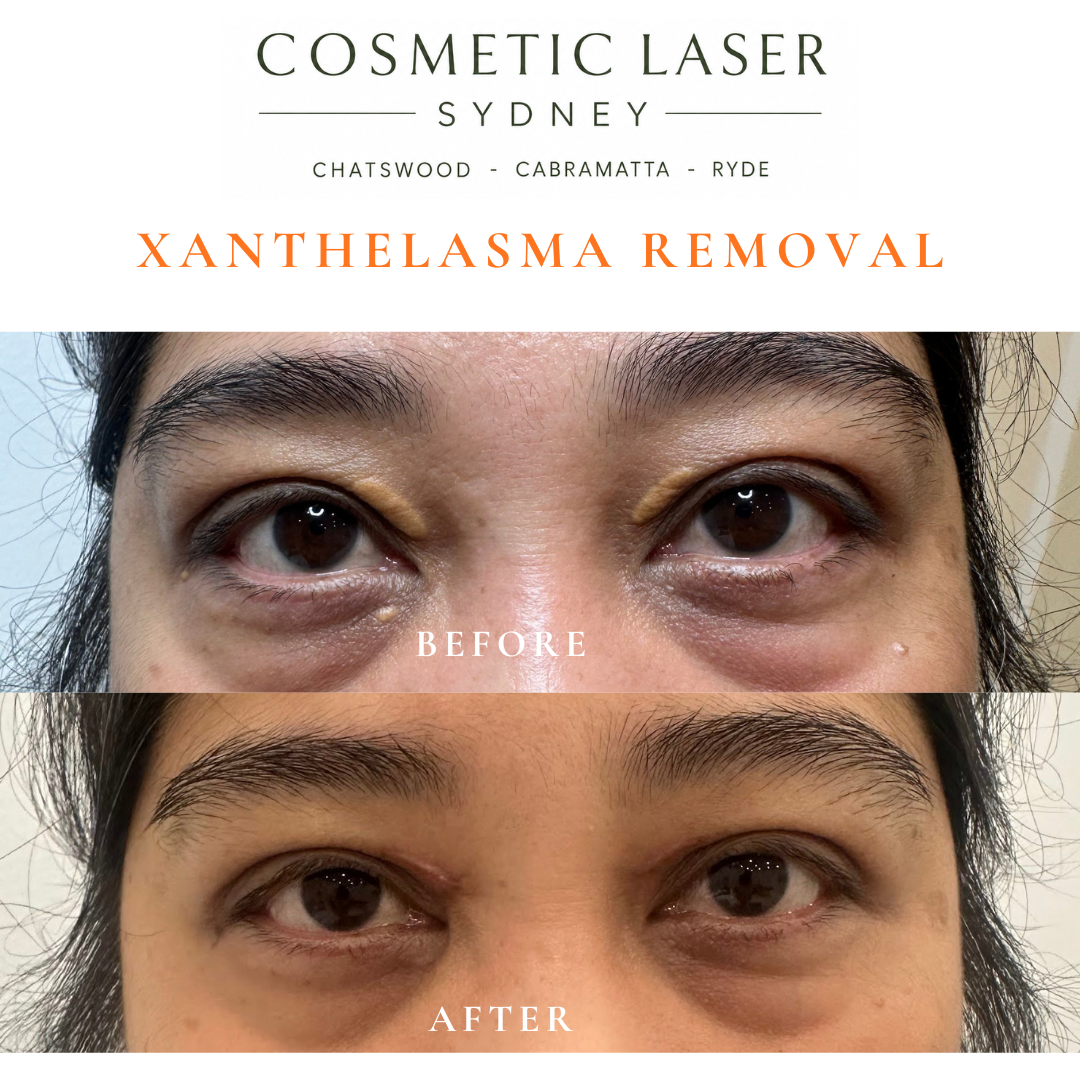 Before and 1-month after CO₂ laser treatment for upper eyelid xanthelasma plaques showing smooth cosmetic healing by Dr Peter Kim.