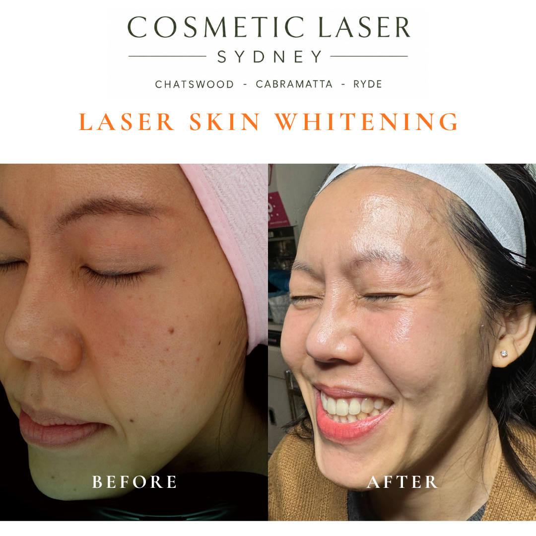 Ten-year result of laser skin whitening treatment for sun damage and freckles, showing long-term skin maintenance by Dr Peter Kim.