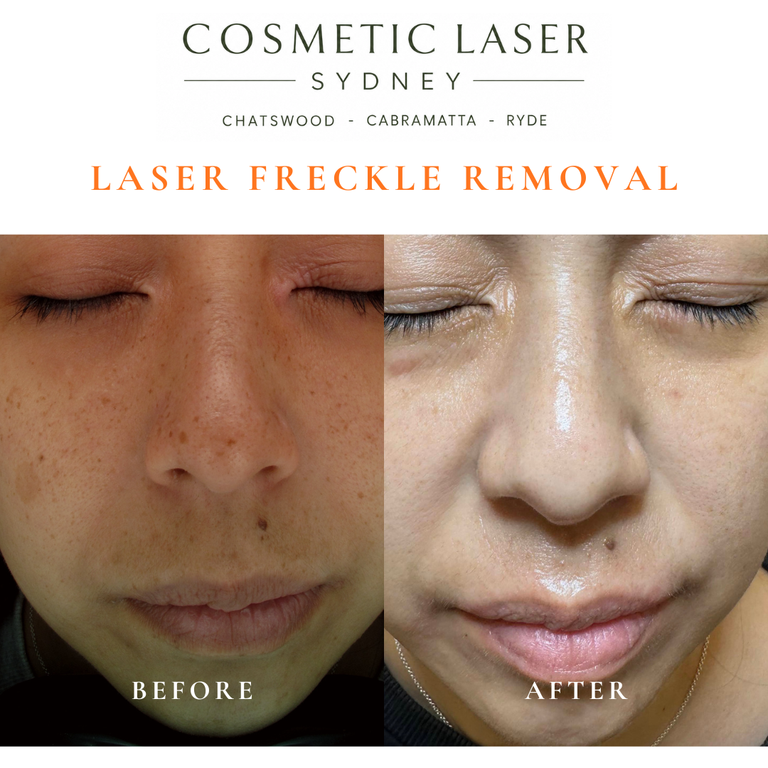 Long-term 3-year follow-up results after laser freckle removal showing sustained skin clarity by Dr Peter Kim.