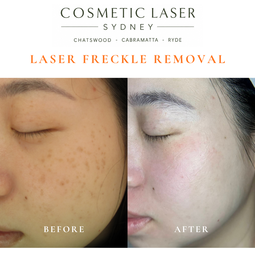 Before and after 4 sessions of medical laser freckle removal on the face showing dramatic pigment clearance by Dr Peter Kim.