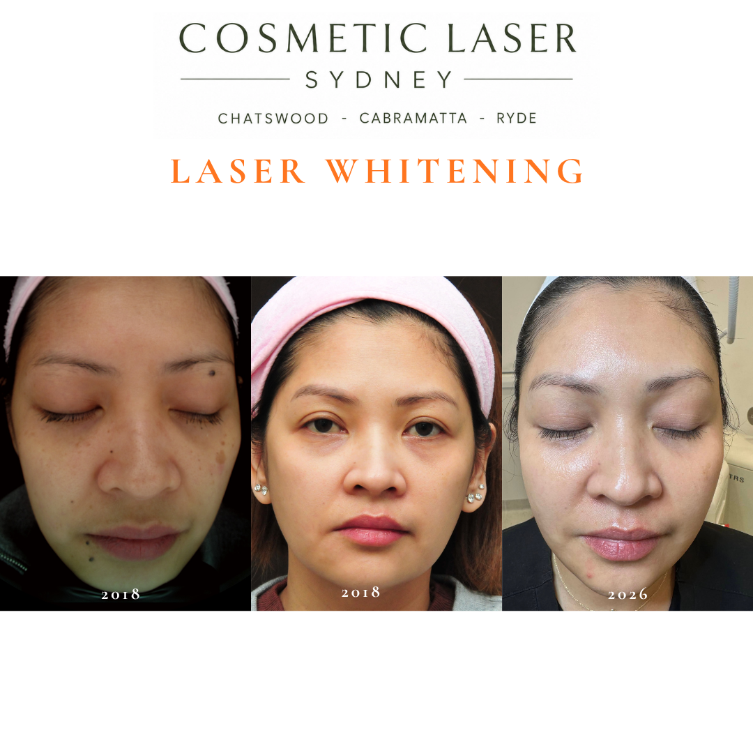 Before and after photos from 2018 and a follow-up in 2026 showing long-term results of laser skin whitening maintenance treatment by Dr Peter Kim.