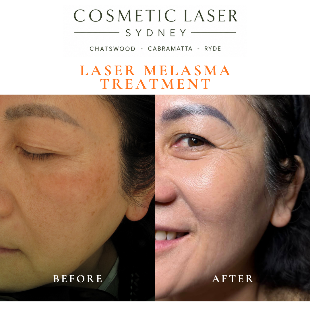 Before and after photos showing long-lasting results of laser melasma and pigmentation treatment on Asian skin using a specialised laser whitening technique by Dr Peter Kim.