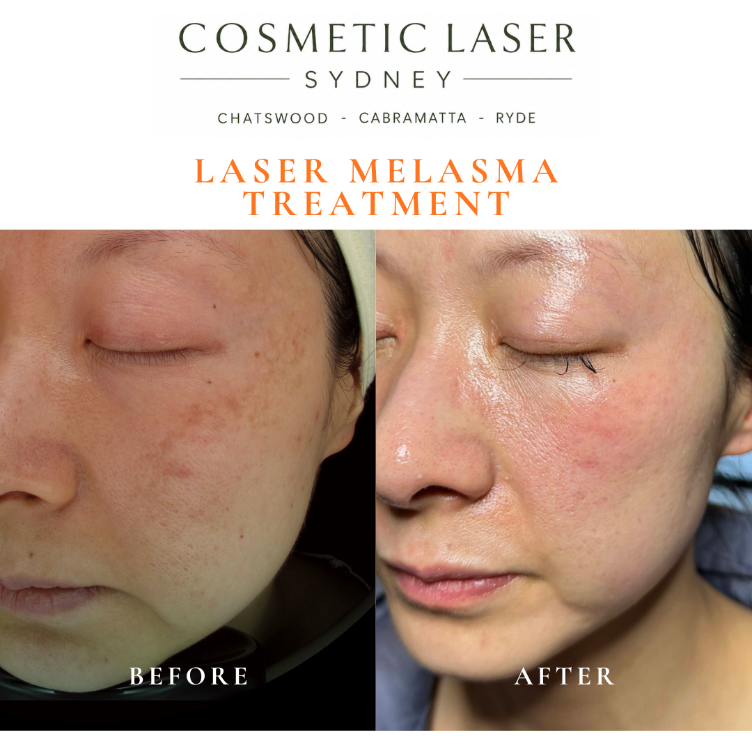 Before and after laser melasma treatment with skin whitening technique on Asian skin showing improved pigmentation and brighter, even skin tone, performed by Dr Peter Kim at Cosmetic Laser Sydney.