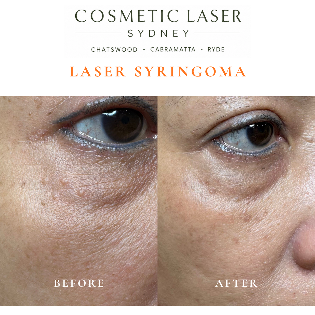 Removal of syringomas around the eyes, a common benign bump often mistaken for milia, performed by Dr Peter Kim.