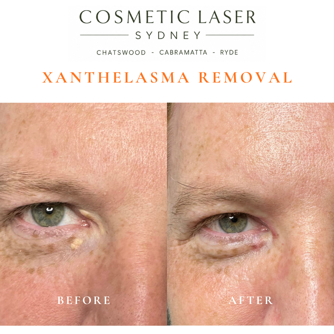 4-week post-treatment photo of CO2 laser xanthelasma removal from upper and lower eyelids, performed by Dr Peter Kim.