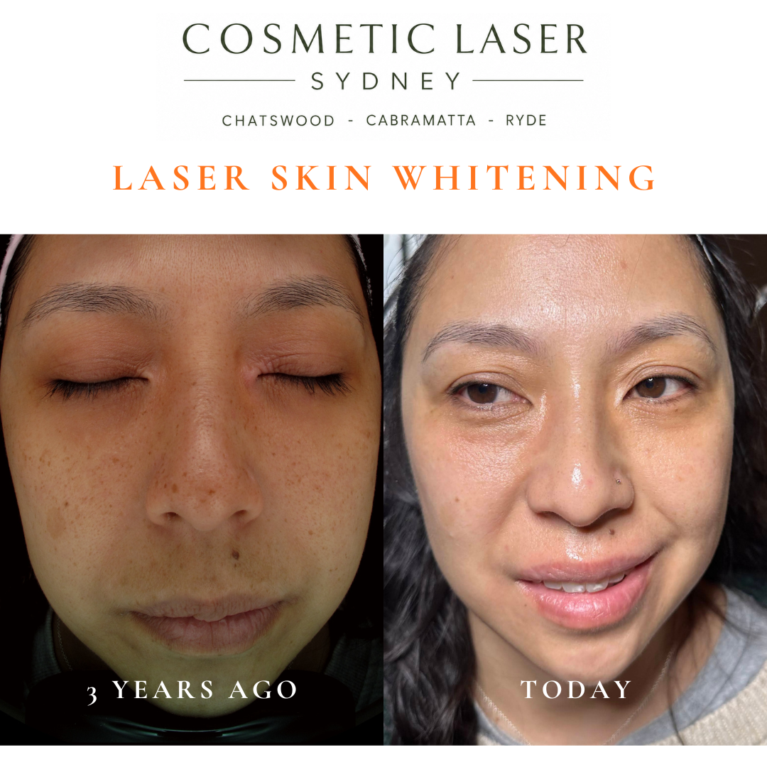 Results of laser skin whitening treatment after four sessions targeting freckles, showing good clearance and long-lasting results, performed by Dr Peter Kim.