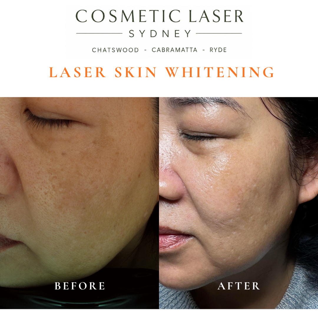 Before and after laser skin whitening treatment for melasma and pigmentation on Asian skin, performed by Dr Peter Kim at Cosmetic Laser Sydney.