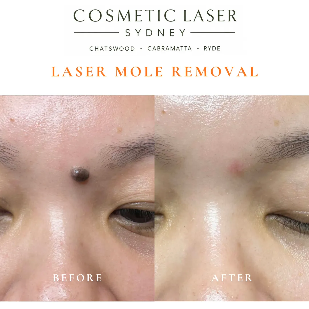 Large forehead mole removed over two sessions using laser mole removal technique, performed by Dr Peter Kim.